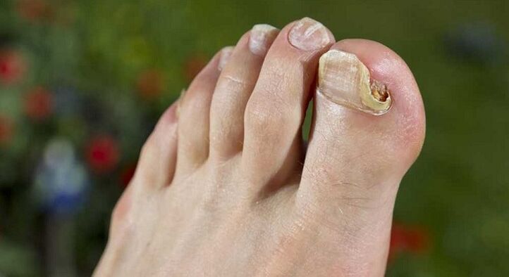 küüneplaadi kahjustus seentega jalgadel