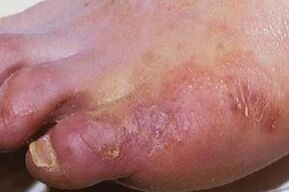 seeninfektsiooni ilmingud jalgade nahal